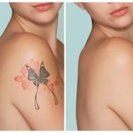 tatoo-removal